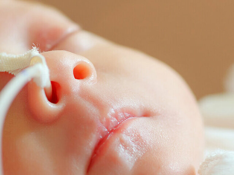Neugeborenes mit Schlauch in Nase auf der Intensivstation