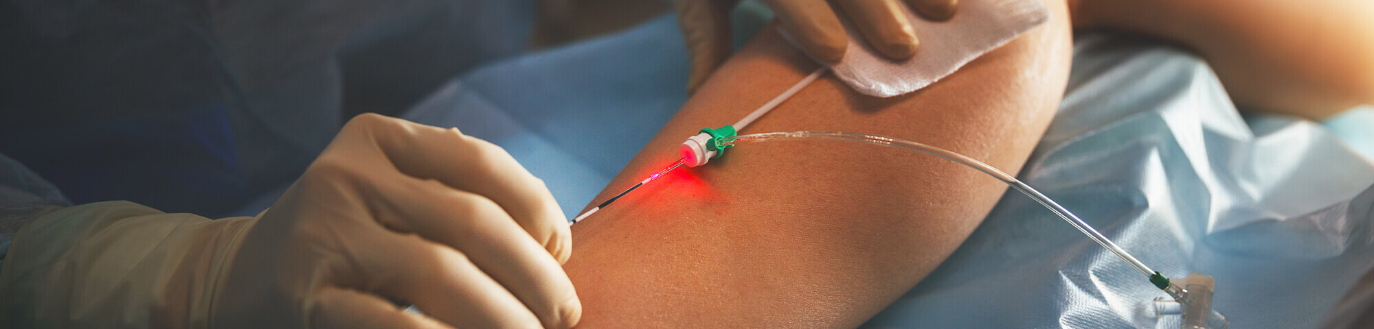 Arzt mit feiner Nadel am Bein einer Patientin bei gefäßchirurgischer Operation