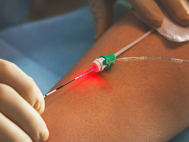 Arzt mit feiner Nadel am Bein einer Patientin bei gefäßchirurgischer Operation