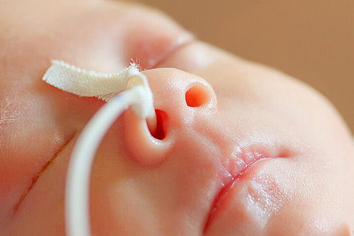 Neugeborenes mit Schlauch in Nase auf der Intensivstation