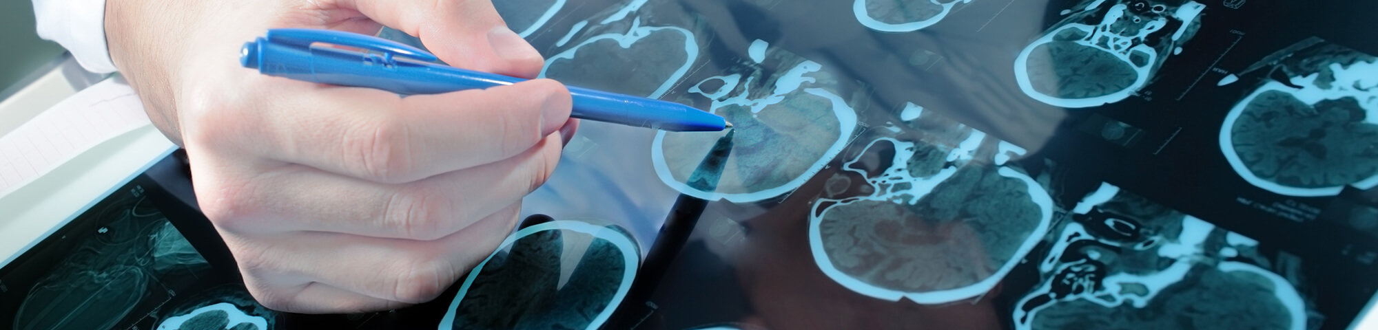 Arzt deutet mit Kugelschreiber auf MRT-Bilder eines Gehirns